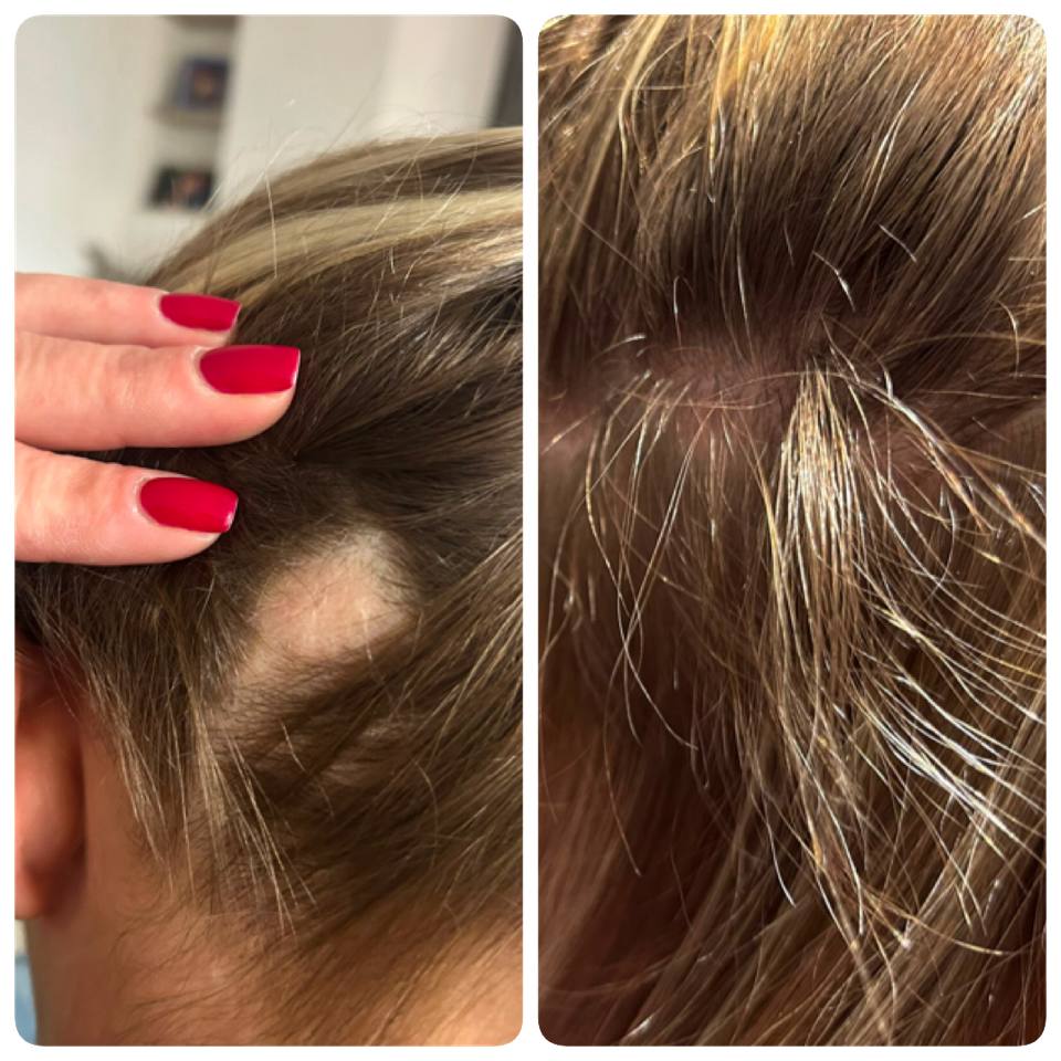 Haarkonzept &ndash; Vorher-Nachher an der Schl&auml;fe, nachgewachsenes Haar